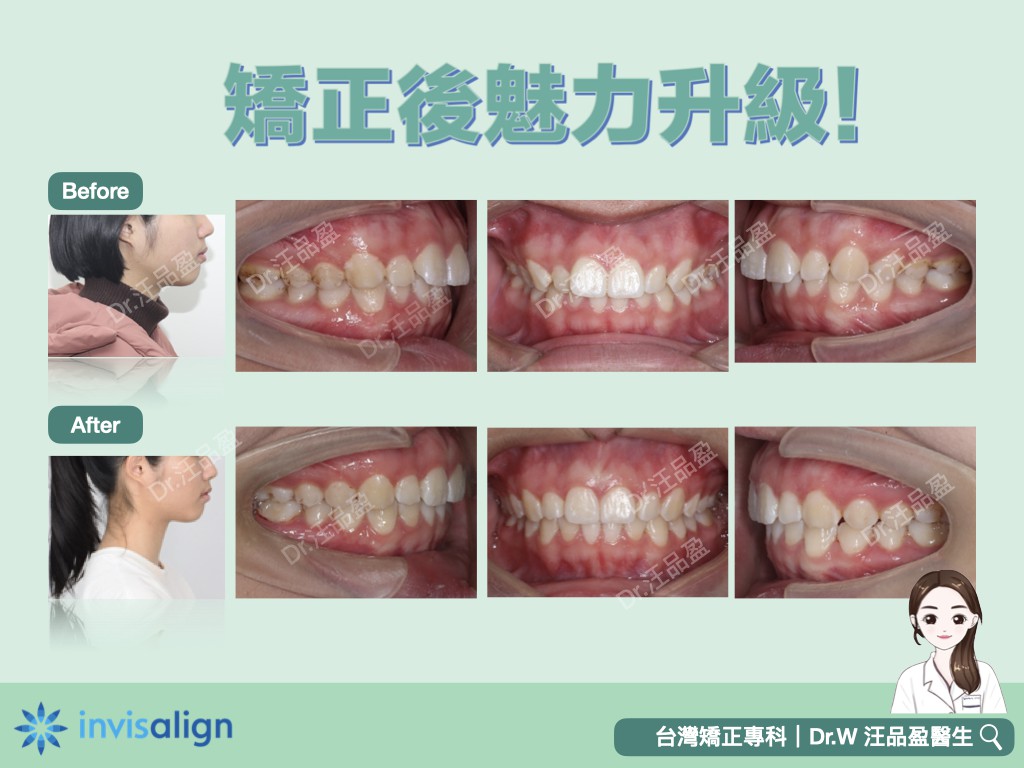 隐适美推磨牙向后改善前突不齐.jpg