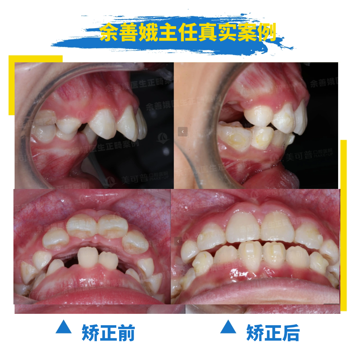案例2：龅牙嘴凸.png