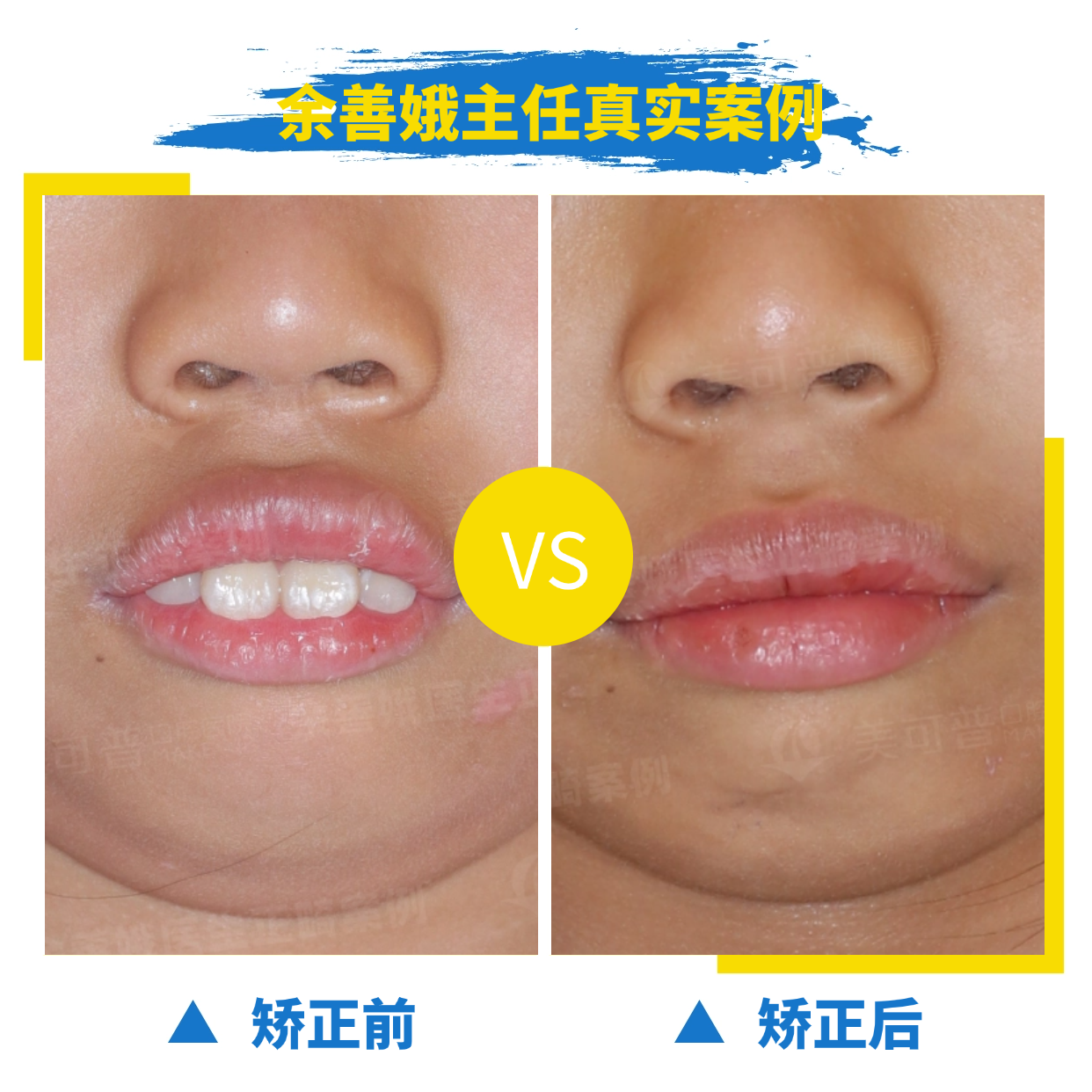 案例3：口呼吸.png