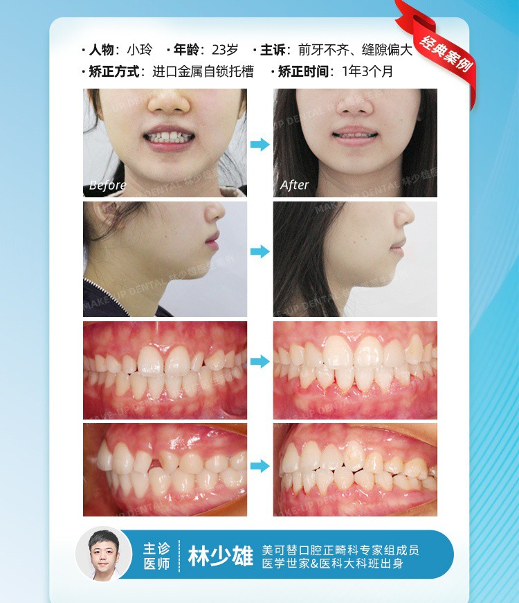 250818-正畸收官案例朋友圈.jpg