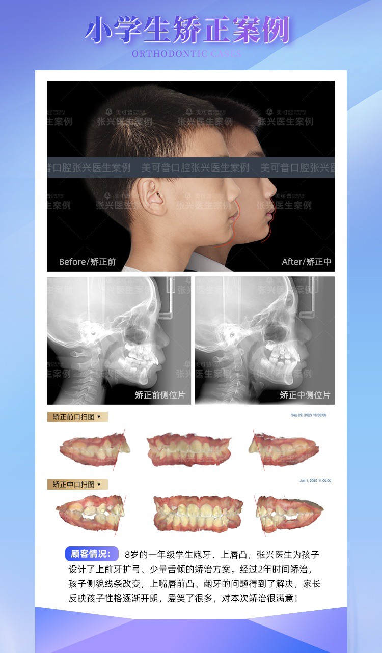 青少年龅牙扩弓矫正.jpg