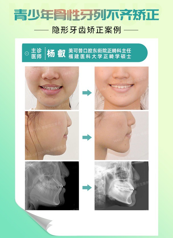 青少年骨性牙列不齐.jpg