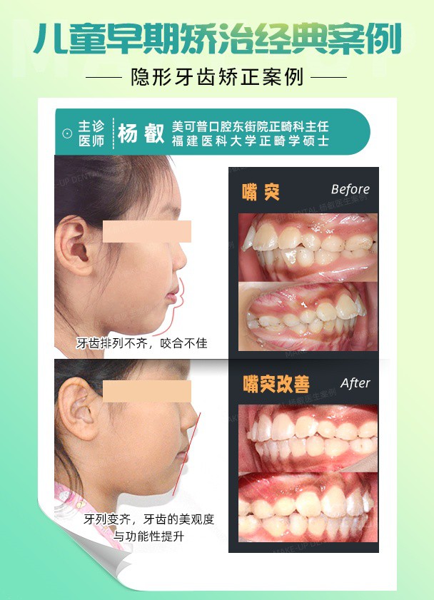 儿童早矫  嘴突.jpg
