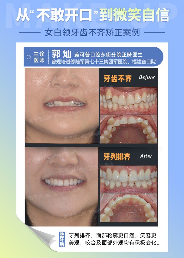 虎牙  牙齿不齐.jpg