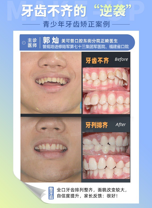 龅牙  牙齿不齐.jpg