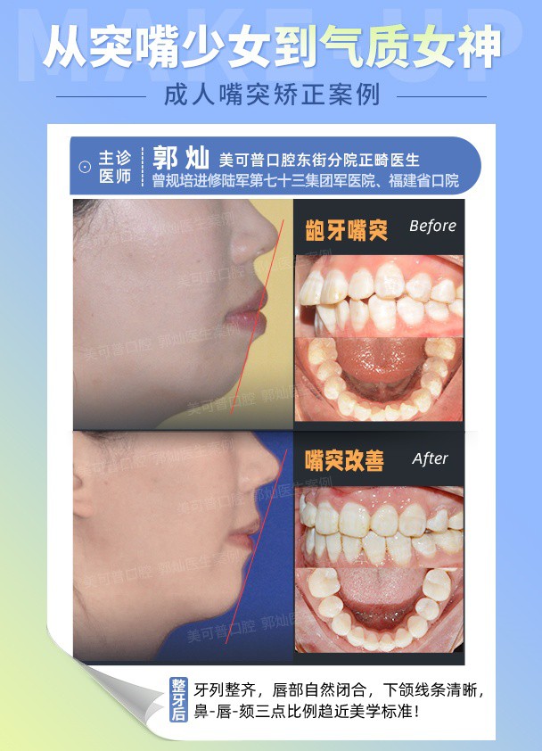 成人嘴突 (2).jpg
