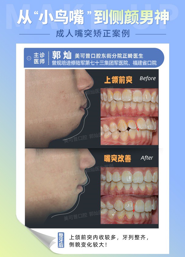 成人嘴突.jpg