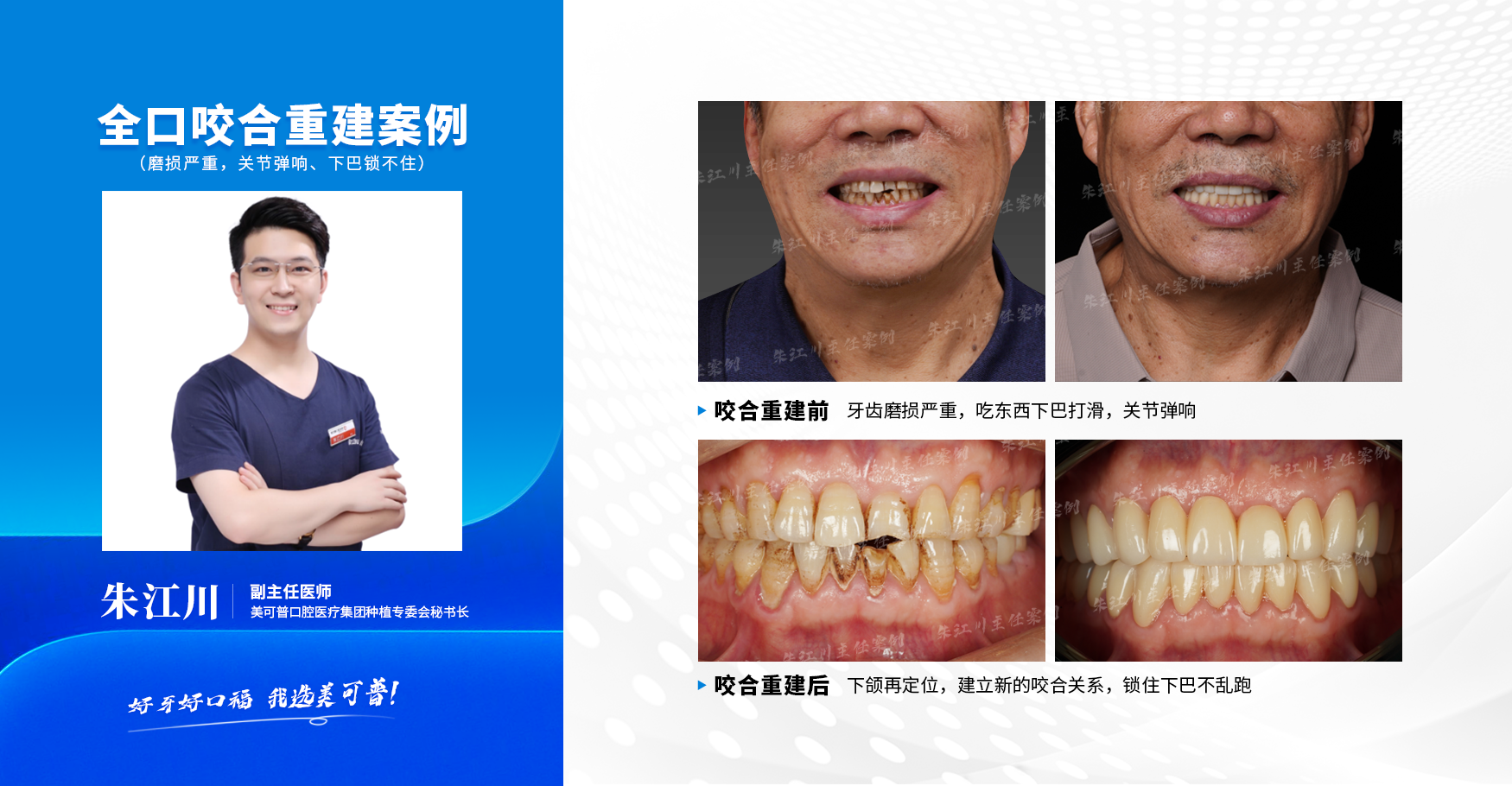 案例4 咬合重建.png